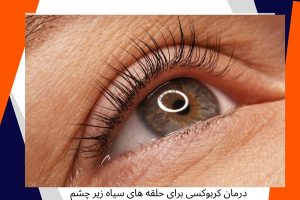 درمان کربوکسی برای حلقه های سیاه زیر چشم