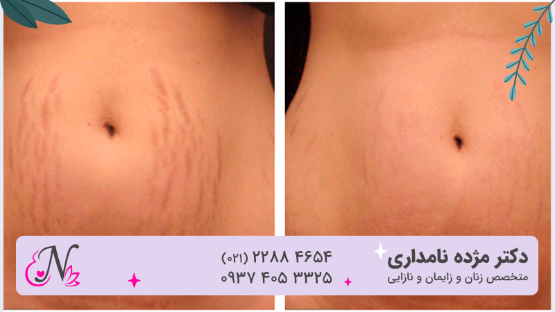 قبل و بعد درمان ترک پوستی عکس استرچ مارک