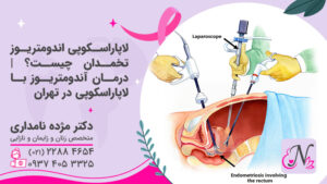 لاپاراسکوپی اندومتریوز تخمدان چیست؟ | درمان آندومتریوز با لاپاراسکوپی در تهران