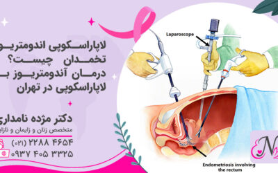 لاپاراسکوپی اندومتریوز تخمدان | درمان آندومتریوز با لاپاراسکوپی در تهران