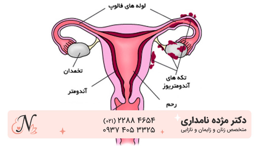 درمان سریع آندومتریوز