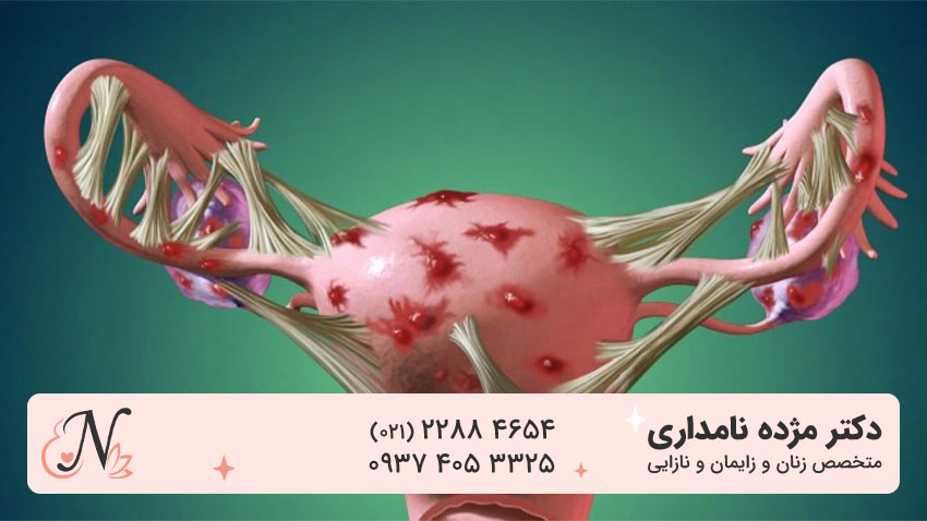 بهترین دکتر برای درمان آندومتریوز