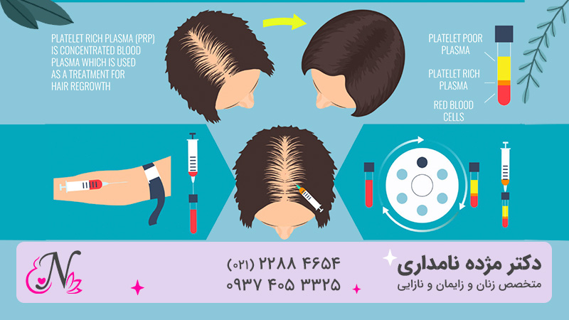 جلوگیری از ریزش مو با PRP