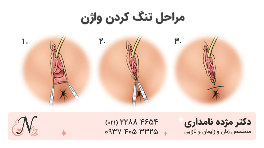 فیلم و عکس عمل زیبایی واژن با بخیه