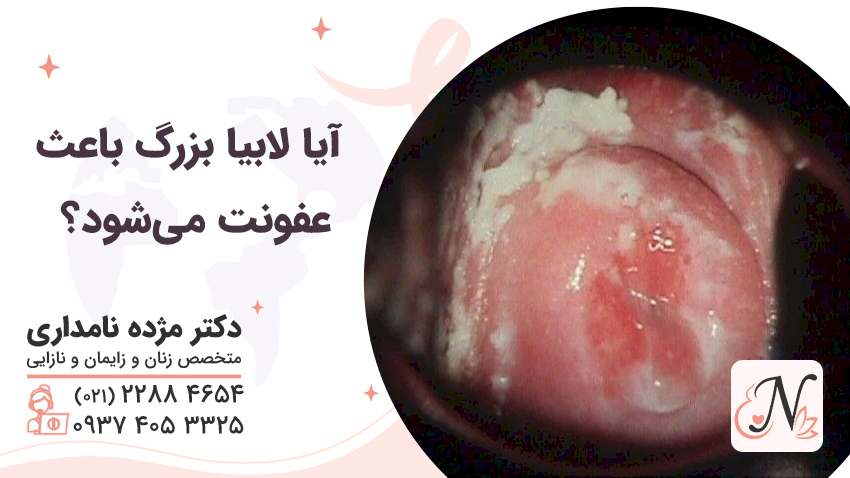 آیا لابیا بزرگ باعث عفونت می‌شود؟