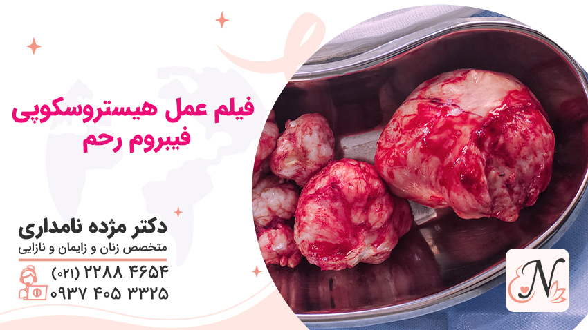 فیلم عمل هیستروسکوپی فیبروم رحم