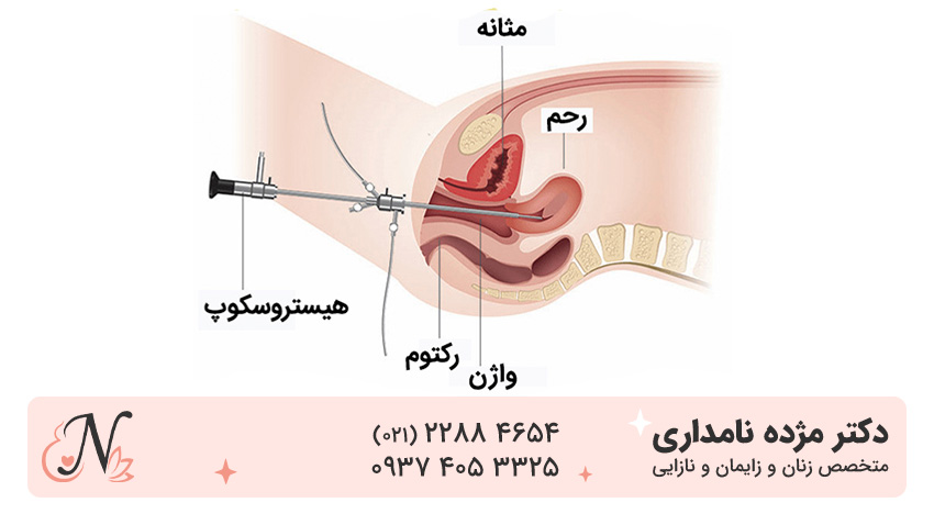 هیستروسکوپی