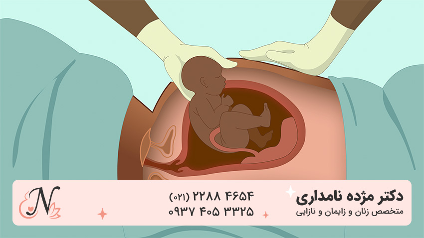 سزارین بیمارستان میلاد