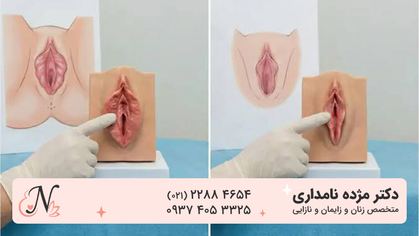 عکس لابیاپلاستی