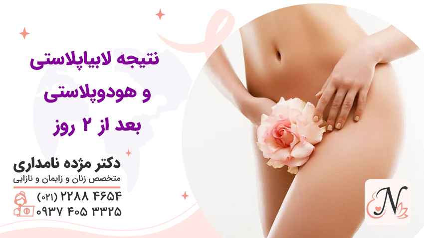 نتیجه لابیاپلاستی و هودوپلاستی بعد از 2 روز