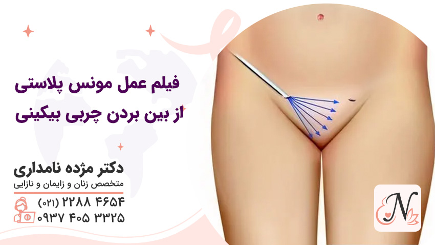 فیلم عمل مونس پلاستی | از بین بردن چربی بیکینی